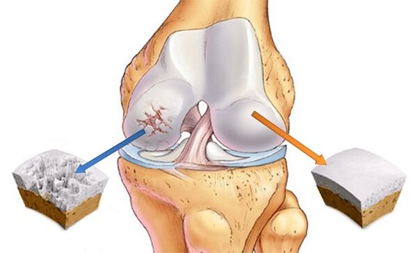Gesunder Knorpel und von Arthrose betroffener Knorpel.