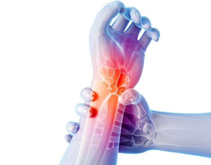 Arthrose der Gelenke geht mit Schmerzen einher und erfordert eine komplexe Behandlung.