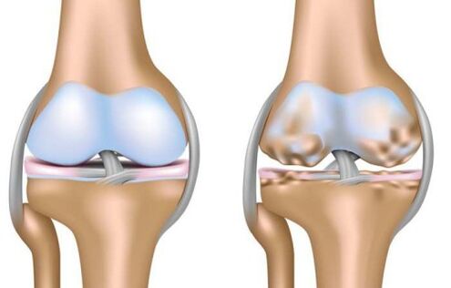 gesundes Gelenk und Zerstörung des Kniegelenks durch Arthrose