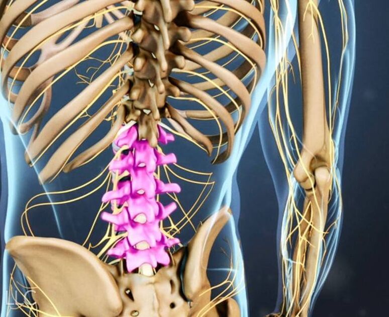 Osteochondrose der Lendenwirbelsäule. 